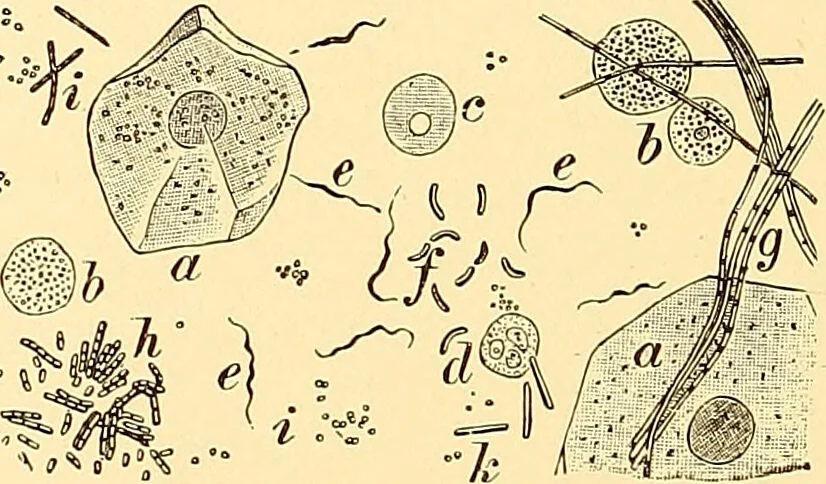 An illustration from Clinical diagnosis : the bacteriological, chemical, and microscopical evidence of disease / by Rudolf v. Jaksch ; tr. from the 3rd German ed. and enlarged by James Cagney ; with numerous illustrations (partly in colours)., 1893, leaf 108
