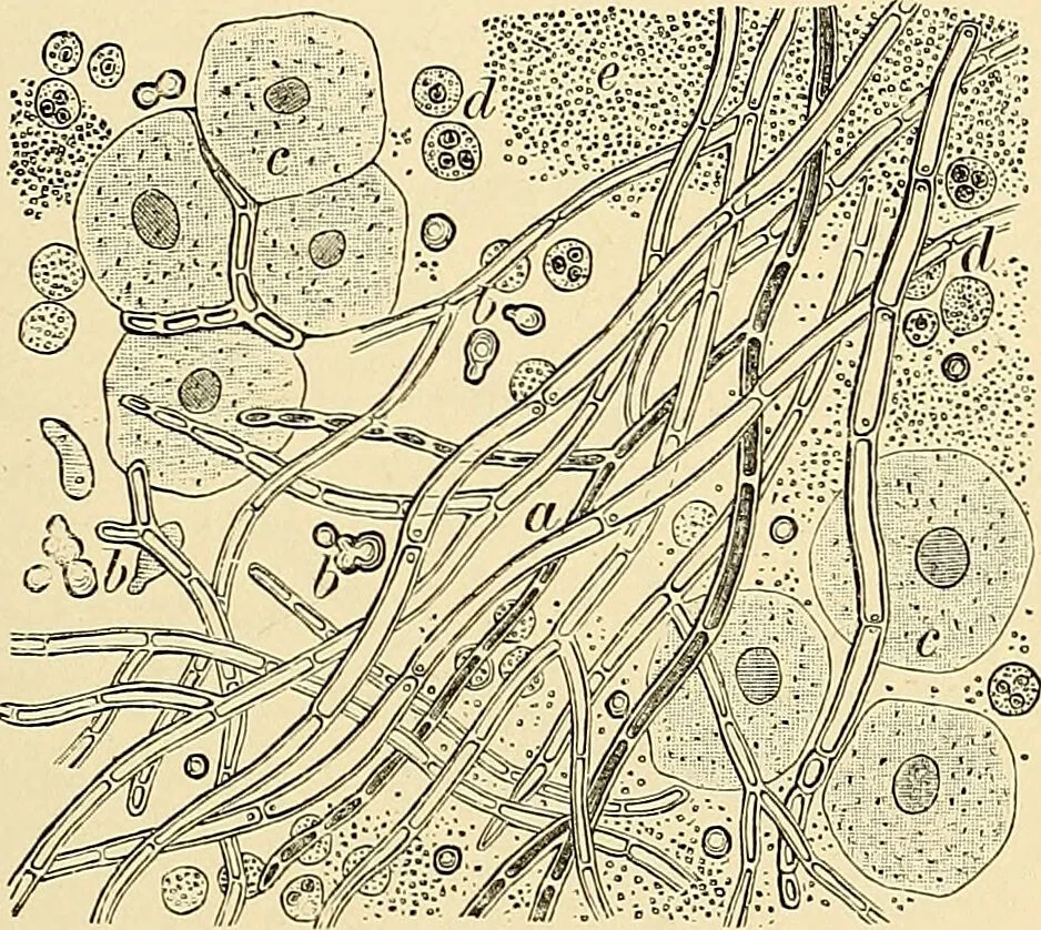 An illustration from Clinical diagnosis : the bacteriological, chemical, and microscopical evidence of disease / by Rudolf v. Jaksch ; tr. from the 3rd German ed. and enlarged by James Cagney ; with numerous illustrations (partly in colours)., 1893, leaf 113