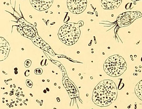 An illustration from Clinical diagnosis : the bacteriological, chemical, and microscopical evidence of disease / by Rudolf v. Jaksch ; tr. from the 3rd German ed. and enlarged by James Cagney ; with numerous illustrations (partly in colours)., 1893, leaf 118
