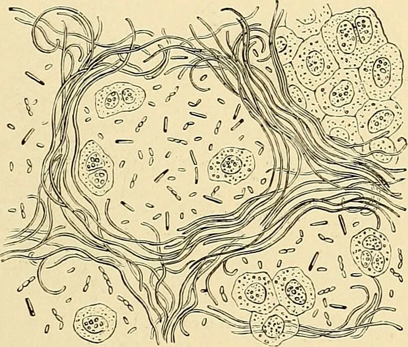 An illustration from Clinical diagnosis : the bacteriological, chemical, and microscopical evidence of disease / by Rudolf v. Jaksch ; tr. from the 3rd German ed. and enlarged by James Cagney ; with numerous illustrations (partly in colours)., 1893, leaf 125