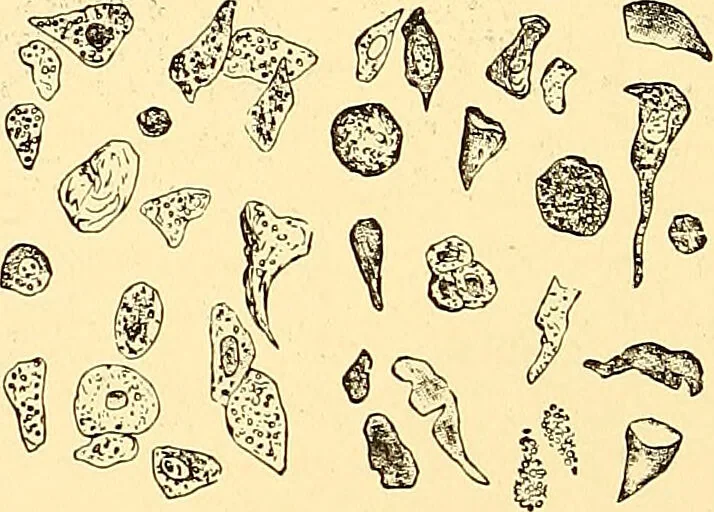 An illustration from Clinical diagnosis : the bacteriological, chemical, and microscopical evidence of disease / by Rudolf v. Jaksch ; tr. from the 3rd German ed. and enlarged by James Cagney ; with numerous illustrations (partly in colours)., 1893, leaf 196