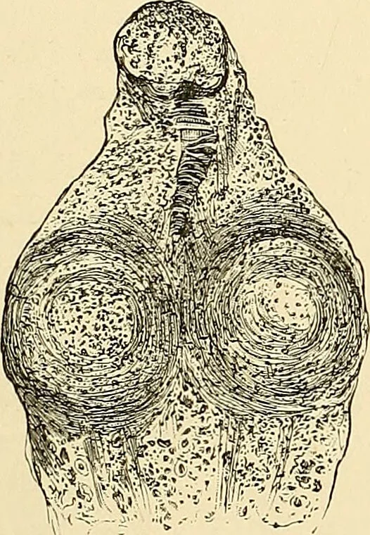 An illustration from Clinical diagnosis : the bacteriological, chemical, and microscopical evidence of disease / by Rudolf v. Jaksch ; tr. from the 3rd German ed. and enlarged by James Cagney ; with numerous illustrations (partly in colours)., 1893, leaf 213