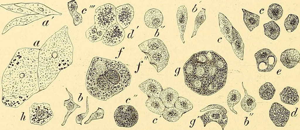 An illustration from Clinical diagnosis : the bacteriological, chemical, and microscopical evidence of disease / by Rudolf v. Jaksch ; tr. from the 3rd German ed. and enlarged by James Cagney ; with numerous illustrations (partly in colours)., 1893, leaf 250