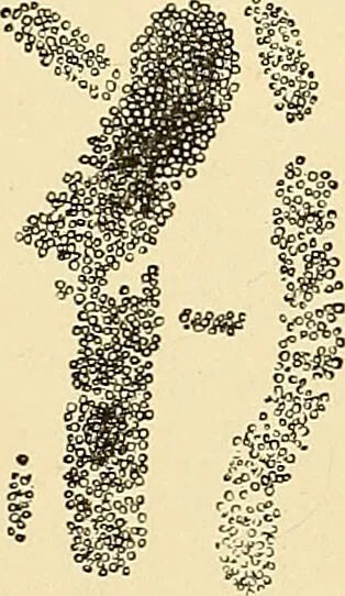 An illustration from Clinical diagnosis : the bacteriological, chemical, and microscopical evidence of disease / by Rudolf v. Jaksch ; tr. from the 3rd German ed. and enlarged by James Cagney ; with numerous illustrations (partly in colours)., 1893, leaf 253