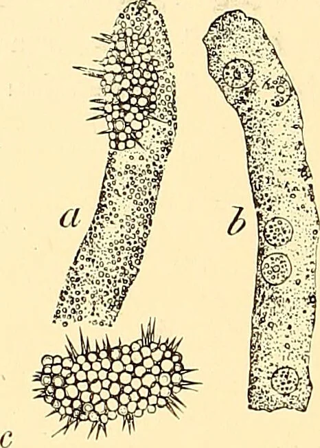 An illustration from Clinical diagnosis : the bacteriological, chemical, and microscopical evidence of disease / by Rudolf v. Jaksch ; tr. from the 3rd German ed. and enlarged by James Cagney ; with numerous illustrations (partly in colours)., 1893, leaf 258