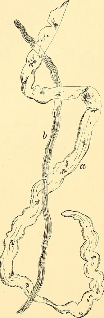 An illustration from Clinical diagnosis : the bacteriological, chemical, and microscopical evidence of disease / by Rudolf v. Jaksch ; tr. from the 3rd German ed. and enlarged by James Cagney ; with numerous illustrations (partly in colours)., 1893, leaf 260