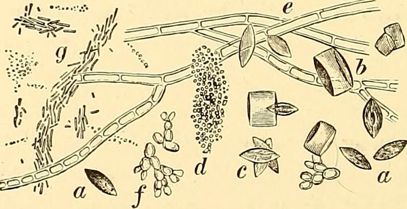 An illustration from Clinical diagnosis : the bacteriological, chemical, and microscopical evidence of disease / by Rudolf v. Jaksch ; tr. from the 3rd German ed. and enlarged by James Cagney ; with numerous illustrations (partly in colours)., 1893, leaf 262