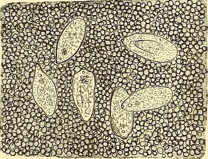 An illustration from Clinical diagnosis : the bacteriological, chemical, and microscopical evidence of disease / by Rudolf v. Jaksch ; tr. from the 3rd German ed. and enlarged by James Cagney ; with numerous illustrations (partly in colours)., 1893, leaf 266
