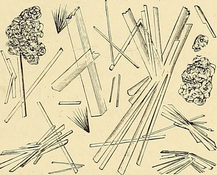 An illustration from Clinical diagnosis : the bacteriological, chemical, and microscopical evidence of disease / by Rudolf v. Jaksch ; tr. from the 3rd German ed. and enlarged by James Cagney ; with numerous illustrations (partly in colours)., 1893, leaf 271