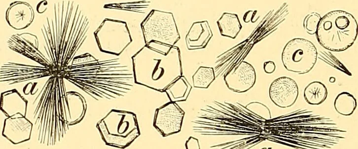 An illustration from Clinical diagnosis : the bacteriological, chemical, and microscopical evidence of disease / by Rudolf v. Jaksch ; tr. from the 3rd German ed. and enlarged by James Cagney ; with numerous illustrations (partly in colours)., 1893, leaf 272