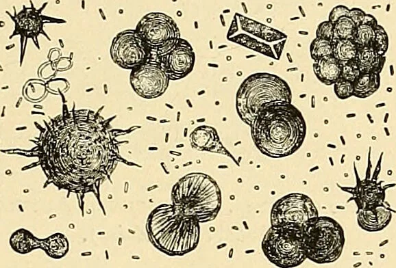 An illustration from Clinical diagnosis : the bacteriological, chemical, and microscopical evidence of disease / by Rudolf v. Jaksch ; tr. from the 3rd German ed. and enlarged by James Cagney ; with numerous illustrations (partly in colours)., 1893, leaf 277