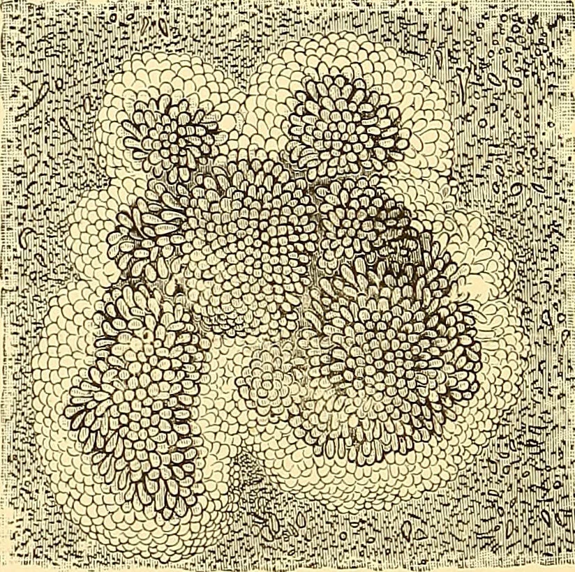 An illustration from Clinical diagnosis : the bacteriological, chemical, and microscopical evidence of disease / by Rudolf v. Jaksch ; tr. from the 3rd German ed. and enlarged by James Cagney ; with numerous illustrations (partly in colours)., 1893, leaf 378