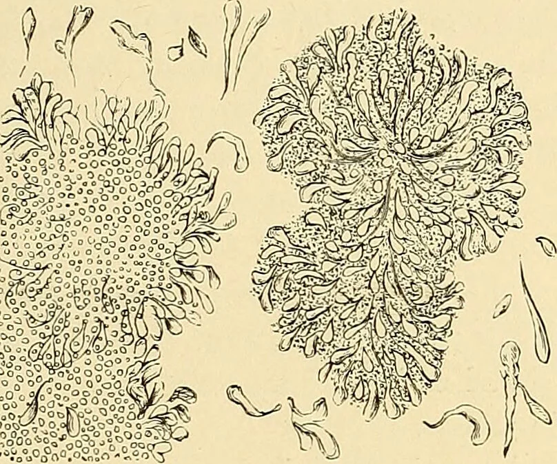 An illustration from Clinical diagnosis : the bacteriological, chemical, and microscopical evidence of disease / by Rudolf v. Jaksch ; tr. from the 3rd German ed. and enlarged by James Cagney ; with numerous illustrations (partly in colours)., 1893, leaf 379