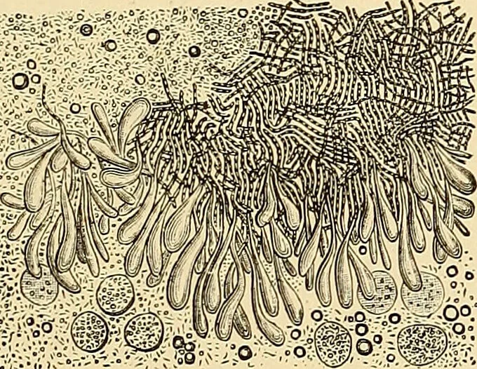 An illustration from Clinical diagnosis : the bacteriological, chemical, and microscopical evidence of disease / by Rudolf v. Jaksch ; tr. from the 3rd German ed. and enlarged by James Cagney ; with numerous illustrations (partly in colours)., 1893, leaf 379
