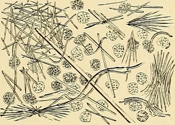 An illustration from Clinical diagnosis : the bacteriological, chemical, and microscopical evidence of disease / by Rudolf v. Jaksch ; tr. from the 3rd German ed. and enlarged by James Cagney ; with numerous illustrations (partly in colours)., 1893, leaf 387
