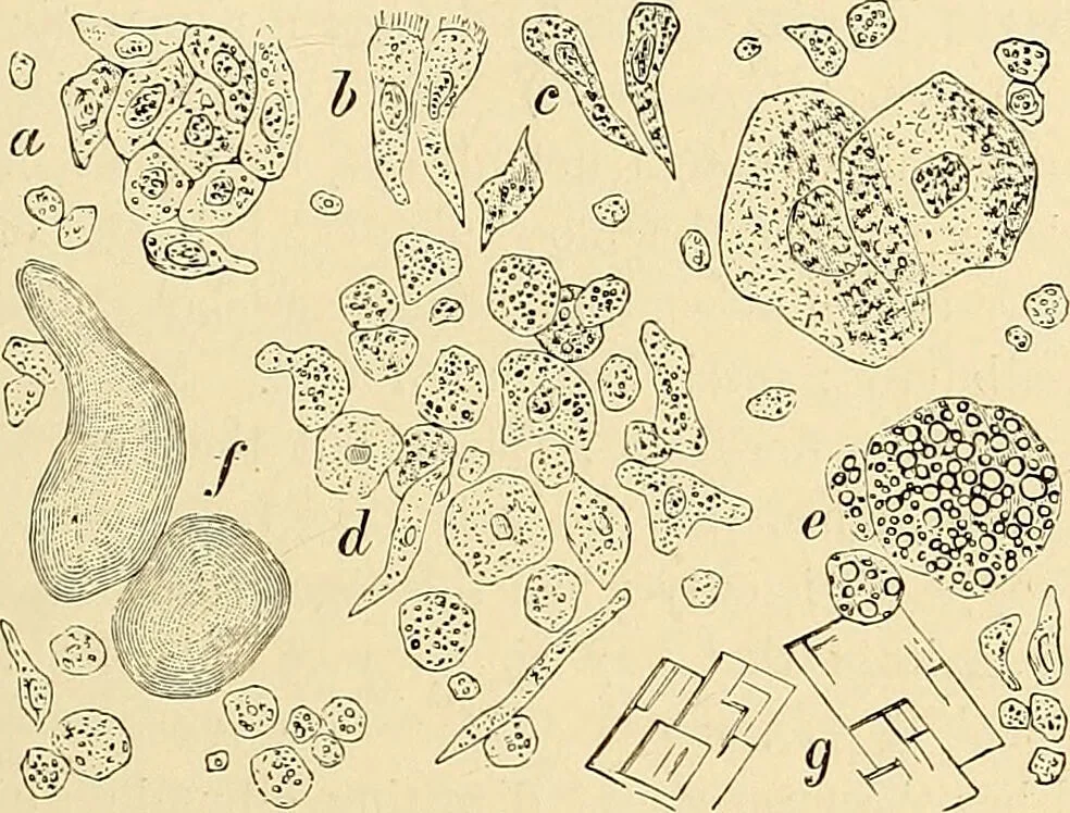 An illustration from Clinical diagnosis : the bacteriological, chemical, and microscopical evidence of disease / by Rudolf v. Jaksch ; tr. from the 3rd German ed. and enlarged by James Cagney ; with numerous illustrations (partly in colours)., 1893, leaf 391