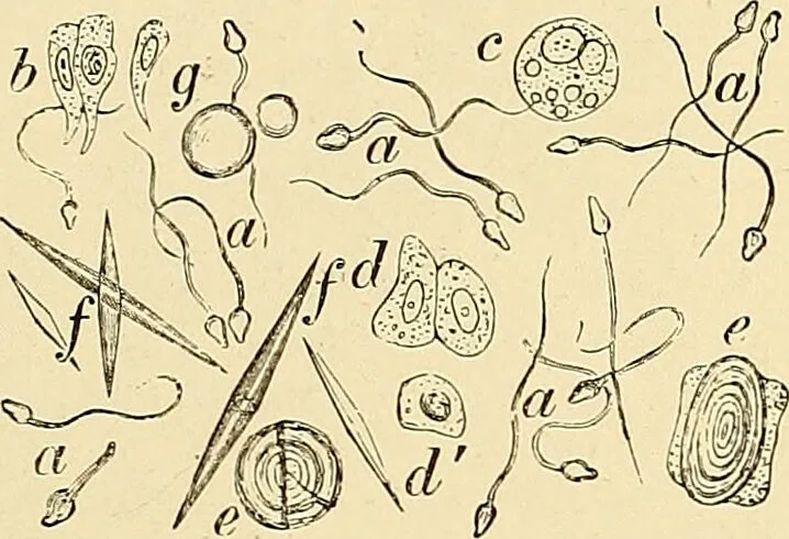 An illustration from Clinical diagnosis : the bacteriological, chemical, and microscopical evidence of disease / by Rudolf v. Jaksch ; tr. from the 3rd German ed. and enlarged by James Cagney ; with numerous illustrations (partly in colours)., 1893, leaf 395