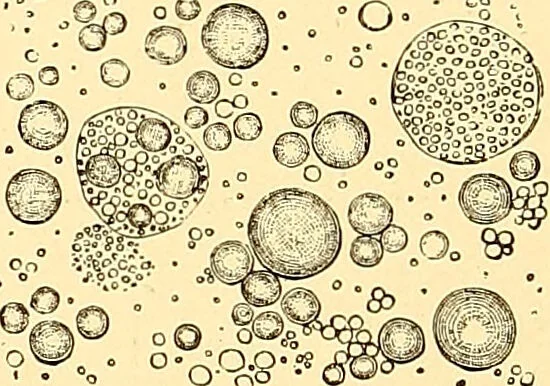 An illustration from Clinical diagnosis : the bacteriological, chemical, and microscopical evidence of disease / by Rudolf v. Jaksch ; tr. from the 3rd German ed. and enlarged by James Cagney ; with numerous illustrations (partly in colours)., 1893, leaf 396