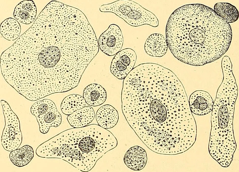 An illustration from Clinical diagnosis : the bacteriological, chemical, and microscopical evidence of disease / by Rudolf v. Jaksch ; tr. from the 3rd German ed. and enlarged by James Cagney ; with numerous illustrations (partly in colours)., 1893, leaf 398