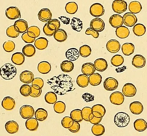 An illustration from Clinical diagnosis : the bacteriological, chemical, and microscopical evidence of disease / by Rudolf v. Jaksch ; tr. from the 3rd German ed. and enlarged by James Cagney ; with numerous illustrations (partly in colours)., 1893, leaf 63