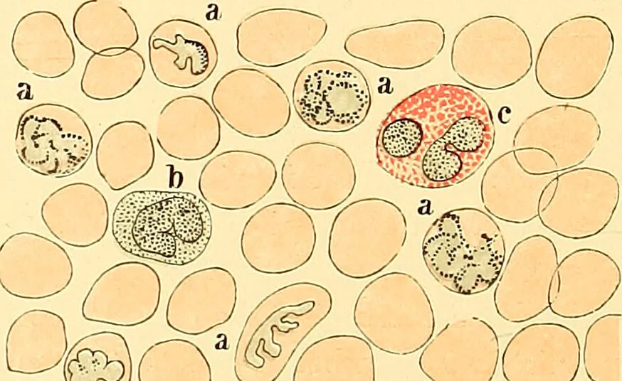 An illustration from Clinical diagnosis : the bacteriological, chemical, and microscopical evidence of disease / by Rudolf v. Jaksch ; tr. from the 3rd German ed. and enlarged by James Cagney ; with numerous illustrations (partly in colours)., 1893, leaf 84
