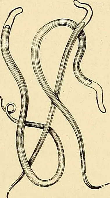 An illustration from Clinical diagnosis : the bacteriological, chemical, and microscopical evidence of disease / by Rudolf v. Jaksch ; tr. from the 3rd German ed. and enlarged by James Cagney ; with numerous illustrations (partly in colours)., 1893, leaf 87