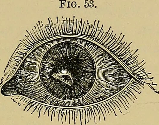 An illustration from Diseases of the eye / by Edward Nettleship ; with a supplement on examinations for color-blindness and acuity of vision and hearing, by William Thomson ; with 5 colored plates and 192 engravings., 1900, leaf 139