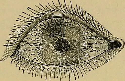 An illustration from Diseases of the eye / by Edward Nettleship ; with a supplement on examinations for color-blindness and acuity of vision and hearing, by William Thomson ; with 5 colored plates and 192 engravings., 1900, leaf 149