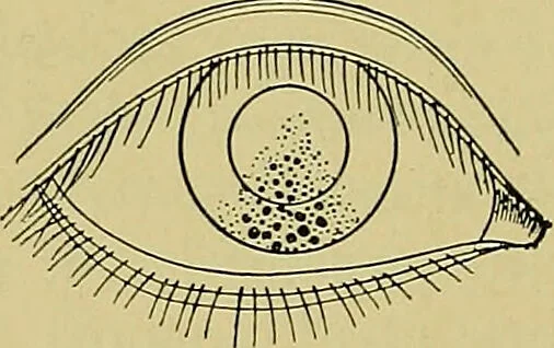 An illustration from Diseases of the eye / by Edward Nettleship ; with a supplement on examinations for color-blindness and acuity of vision and hearing, by William Thomson ; with 5 colored plates and 192 engravings., 1900, leaf 154