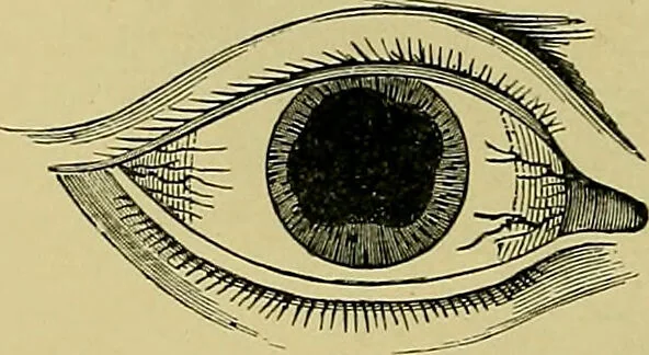 An illustration from Diseases of the eye / by Edward Nettleship ; with a supplement on examinations for color-blindness and acuity of vision and hearing, by William Thomson ; with 5 colored plates and 192 engravings., 1900, leaf 162