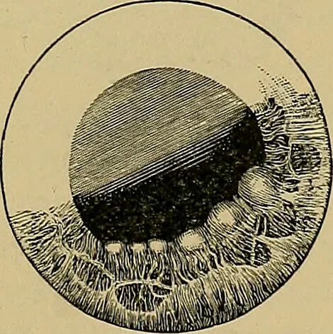 An illustration from Diseases of the eye / by Edward Nettleship ; with a supplement on examinations for color-blindness and acuity of vision and hearing, by William Thomson ; with 5 colored plates and 192 engravings., 1900, leaf 165