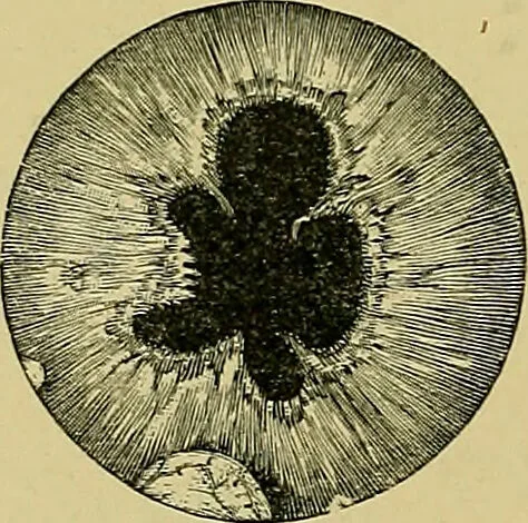 An illustration from Diseases of the eye / by Edward Nettleship ; with a supplement on examinations for color-blindness and acuity of vision and hearing, by William Thomson ; with 5 colored plates and 192 engravings., 1900, leaf 166