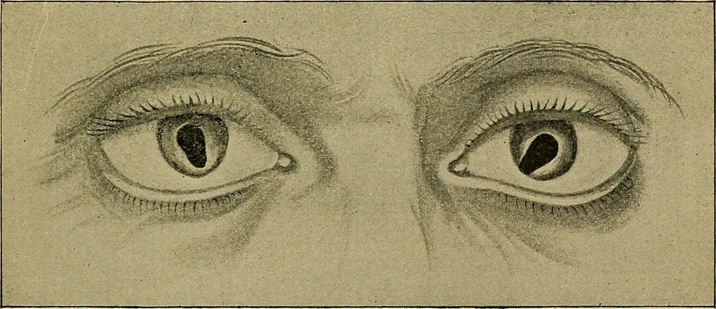 An illustration from Diseases of the eye / by Edward Nettleship ; with a supplement on examinations for color-blindness and acuity of vision and hearing, by William Thomson ; with 5 colored plates and 192 engravings., 1900, leaf 171
