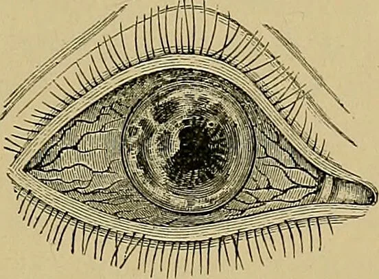 An illustration from Diseases of the eye / by Edward Nettleship ; with a supplement on examinations for color-blindness and acuity of vision and hearing, by William Thomson ; with 5 colored plates and 192 engravings., 1900, leaf 175