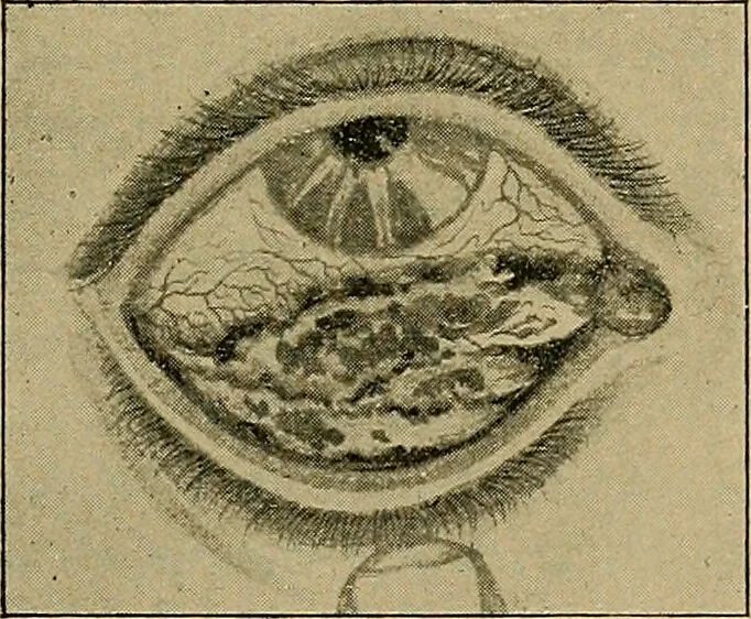 An illustration from Diseases of the eye / by Edward Nettleship ; with a supplement on examinations for color-blindness and acuity of vision and hearing, by William Thomson ; with 5 colored plates and 192 engravings., 1900, leaf 191