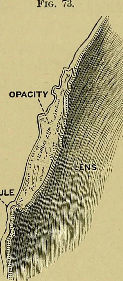 An illustration from Diseases of the eye / by Edward Nettleship ; with a supplement on examinations for color-blindness and acuity of vision and hearing, by William Thomson ; with 5 colored plates and 192 engravings., 1900, leaf 202