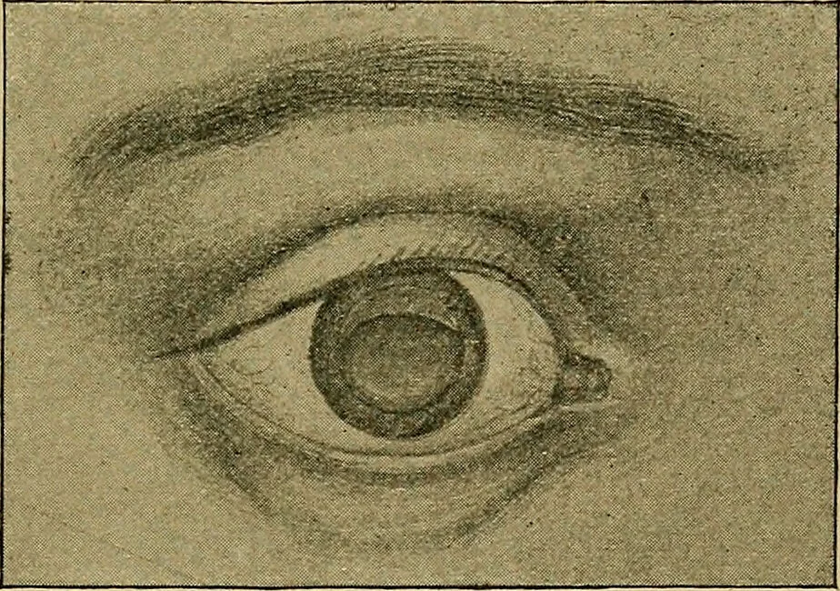 An illustration from Diseases of the eye / by Edward Nettleship ; with a supplement on examinations for color-blindness and acuity of vision and hearing, by William Thomson ; with 5 colored plates and 192 engravings., 1900, leaf 217