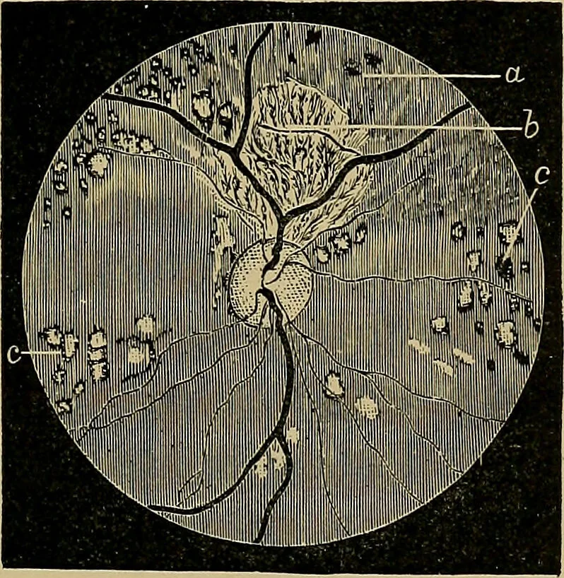An illustration from Diseases of the eye / by Edward Nettleship ; with a supplement on examinations for color-blindness and acuity of vision and hearing, by William Thomson ; with 5 colored plates and 192 engravings., 1900, leaf 223