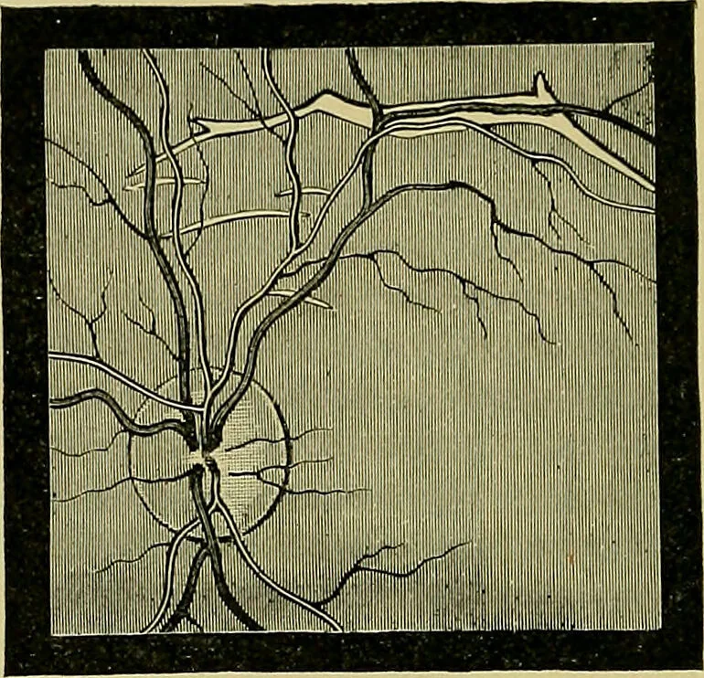 An illustration from Diseases of the eye / by Edward Nettleship ; with a supplement on examinations for color-blindness and acuity of vision and hearing, by William Thomson ; with 5 colored plates and 192 engravings., 1900, leaf 226