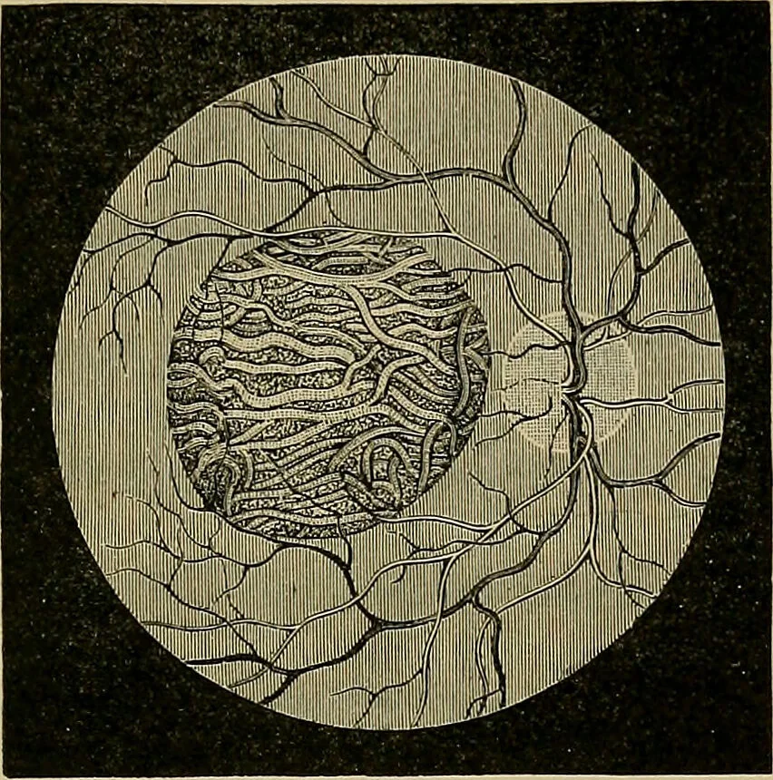 An illustration from Diseases of the eye / by Edward Nettleship ; with a supplement on examinations for color-blindness and acuity of vision and hearing, by William Thomson ; with 5 colored plates and 192 engravings., 1900, leaf 231