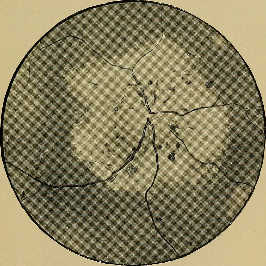 An illustration from Diseases of the eye / by Edward Nettleship ; with a supplement on examinations for color-blindness and acuity of vision and hearing, by William Thomson ; with 5 colored plates and 192 engravings., 1900, leaf 241