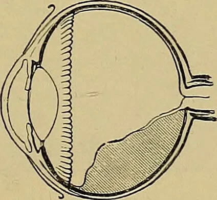 An illustration from Diseases of the eye / by Edward Nettleship ; with a supplement on examinations for color-blindness and acuity of vision and hearing, by William Thomson ; with 5 colored plates and 192 engravings., 1900, leaf 245