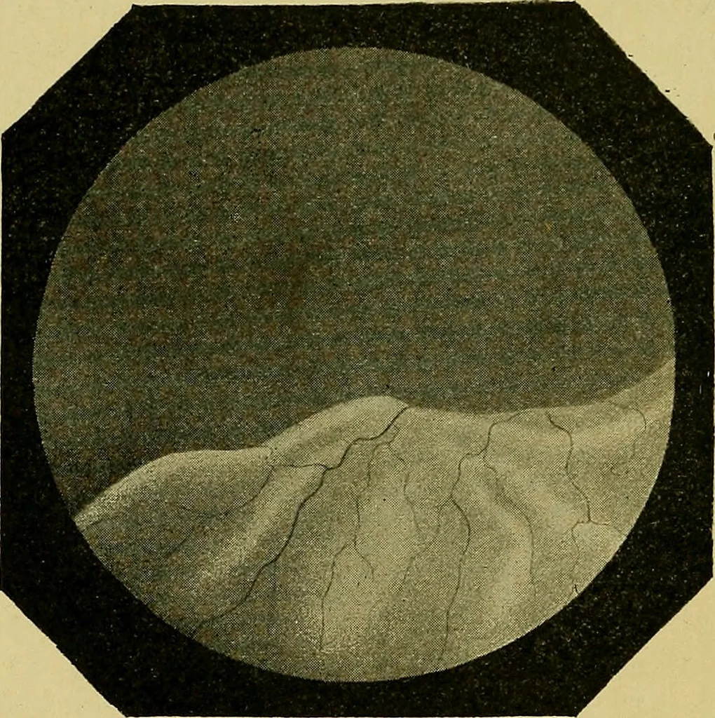An illustration from Diseases of the eye / by Edward Nettleship ; with a supplement on examinations for color-blindness and acuity of vision and hearing, by William Thomson ; with 5 colored plates and 192 engravings., 1900, leaf 246