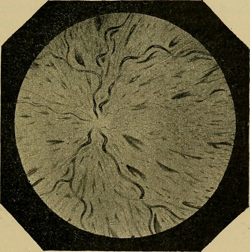 An illustration from Diseases of the eye / by Edward Nettleship ; with a supplement on examinations for color-blindness and acuity of vision and hearing, by William Thomson ; with 5 colored plates and 192 engravings., 1900, leaf 253