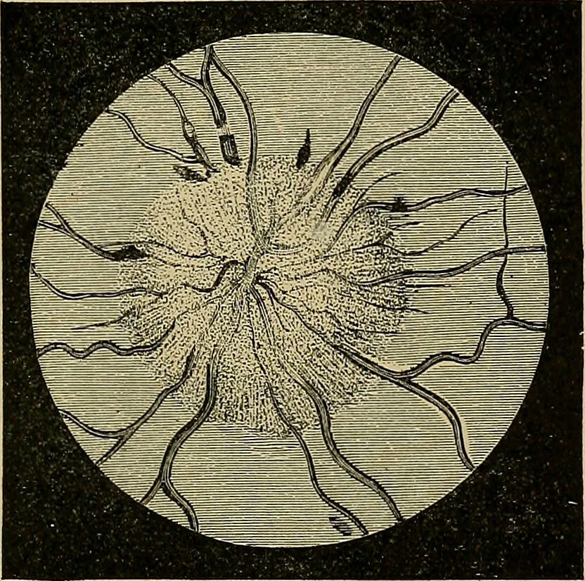 An illustration from Diseases of the eye / by Edward Nettleship ; with a supplement on examinations for color-blindness and acuity of vision and hearing, by William Thomson ; with 5 colored plates and 192 engravings., 1900, leaf 267