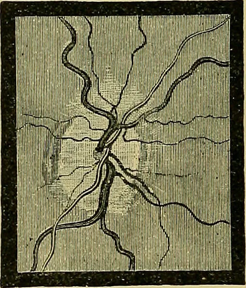 An illustration from Diseases of the eye / by Edward Nettleship ; with a supplement on examinations for color-blindness and acuity of vision and hearing, by William Thomson ; with 5 colored plates and 192 engravings., 1900, leaf 268