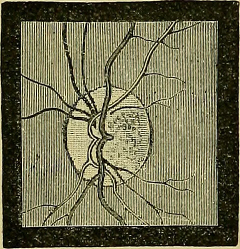 An illustration from Diseases of the eye / by Edward Nettleship ; with a supplement on examinations for color-blindness and acuity of vision and hearing, by William Thomson ; with 5 colored plates and 192 engravings., 1900, leaf 272
