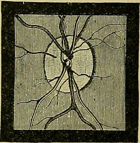 An illustration from Diseases of the eye / by Edward Nettleship ; with a supplement on examinations for color-blindness and acuity of vision and hearing, by William Thomson ; with 5 colored plates and 192 engravings., 1900, leaf 272