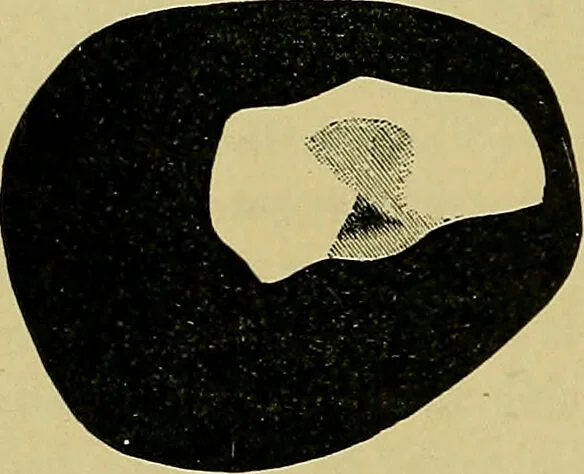 An illustration from Diseases of the eye / by Edward Nettleship ; with a supplement on examinations for color-blindness and acuity of vision and hearing, by William Thomson ; with 5 colored plates and 192 engravings., 1900, leaf 274