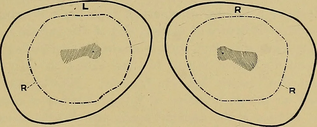 An illustration from Diseases of the eye / by Edward Nettleship ; with a supplement on examinations for color-blindness and acuity of vision and hearing, by William Thomson ; with 5 colored plates and 192 engravings., 1900, leaf 283